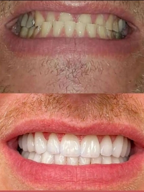 Protocolo (prótese sobre implantes) superior e inferior (Foto: Divulgação) 