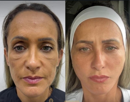 Harmonização facial - lifting cirúrgico (Foto: Divulgação) 