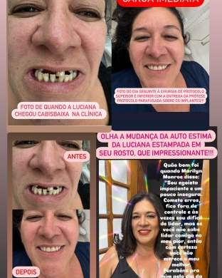 Implante dentário (Imagem: Reprodução/Divulgação) 