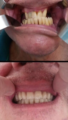 Protocolo (prótese sobre implantes) superior e inferior (Foto: Divulgação) 