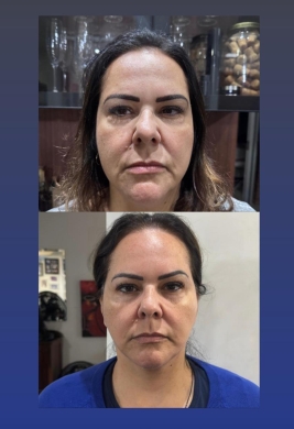 Harmonização facial - lifting cirúrgico (Foto: Divulgação) 