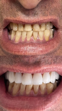 Facetas de resina de alta performance, superiores, (Foto: Divulgação) 